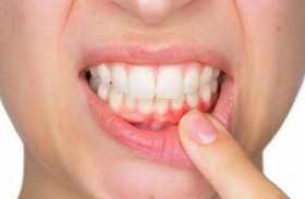 نزيف اللثة ينذر بالتهاب دواعم السن!