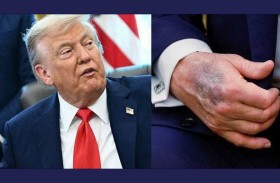 البيت الأبيض يكشف سبب الكدمات على يد ترامب