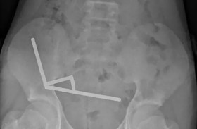 طفل يبتلع 100 مغناطيس 