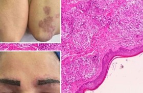 صيحة تجميل شائعة تُصيب امرأة بمرض نادر